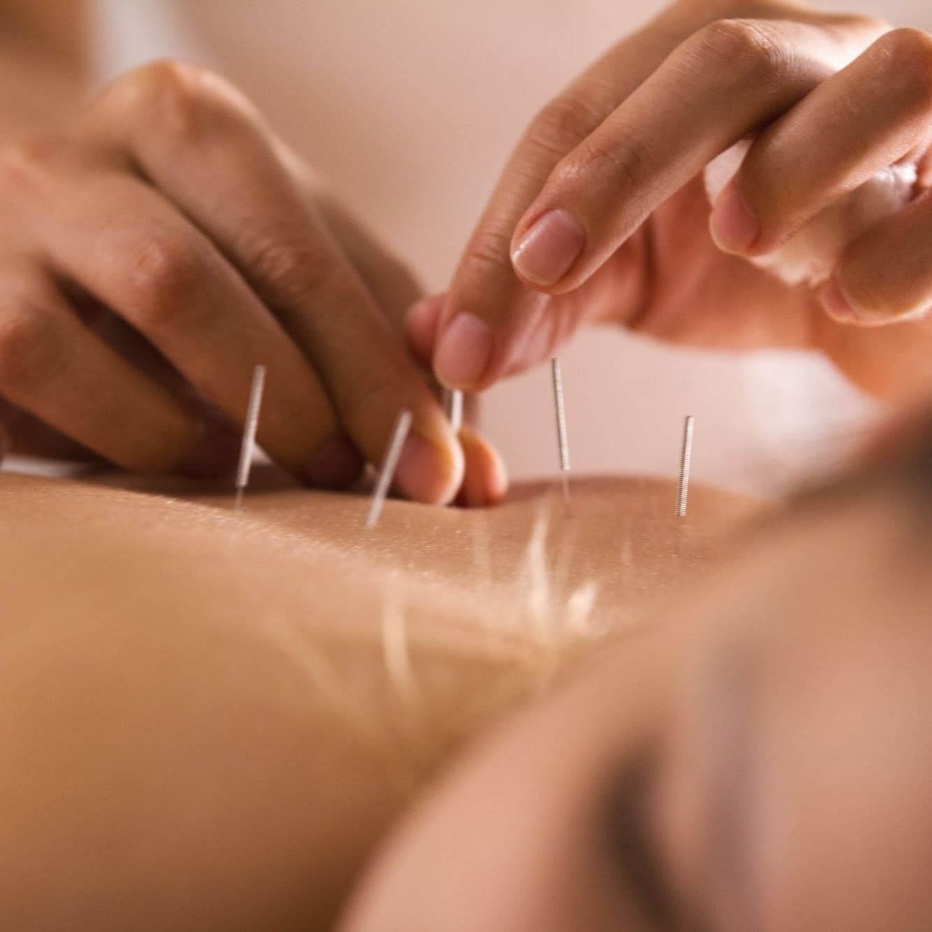 ProCare Acupuncture & Wellness