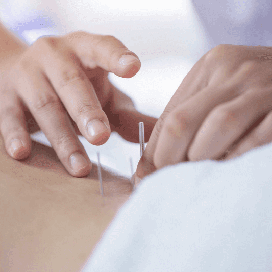 Acupuncture